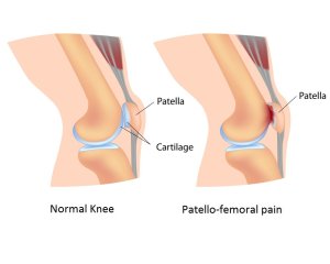 Diagram of a normal knee alongside a knee with petelofemoral pain
